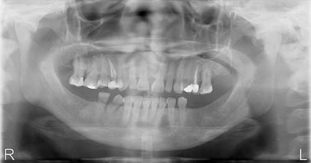 Is This A Case of Odontogenic Neoplasm