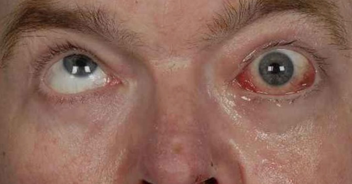 Brief Review On Ocular Symptoms Of Brain Stem Stroke Syndrome