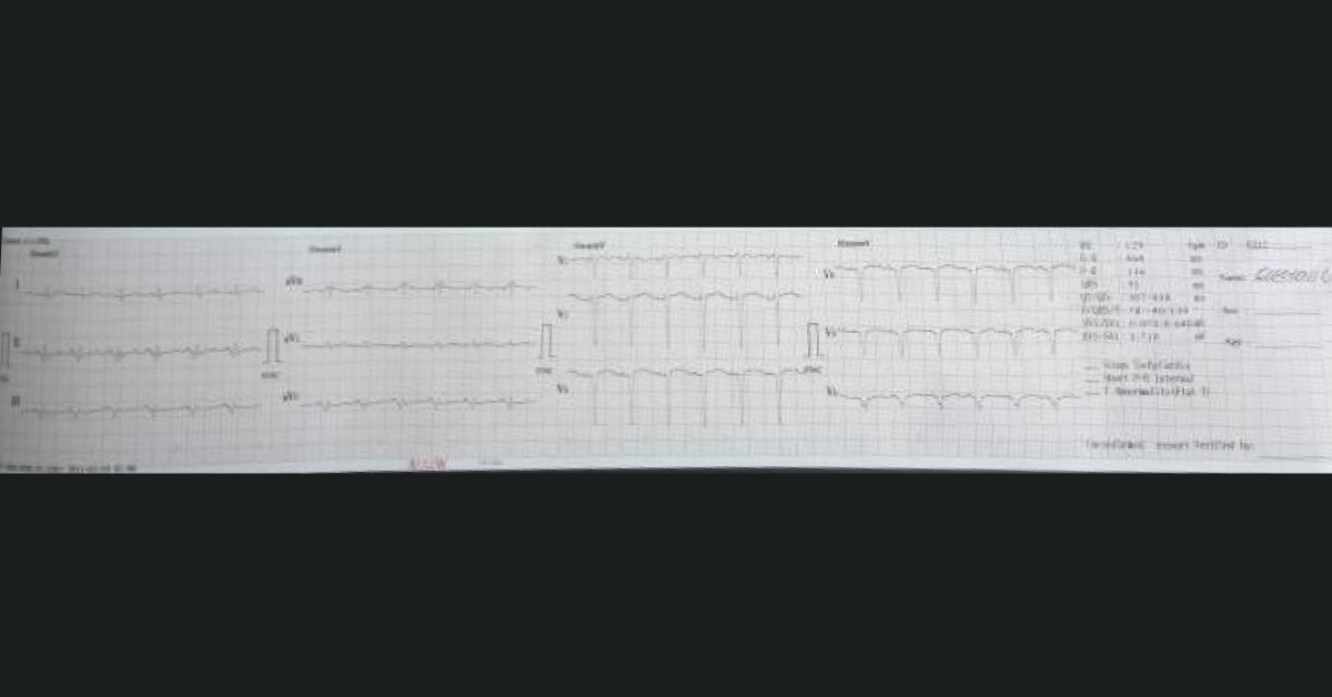 What To Suspect In ECG?