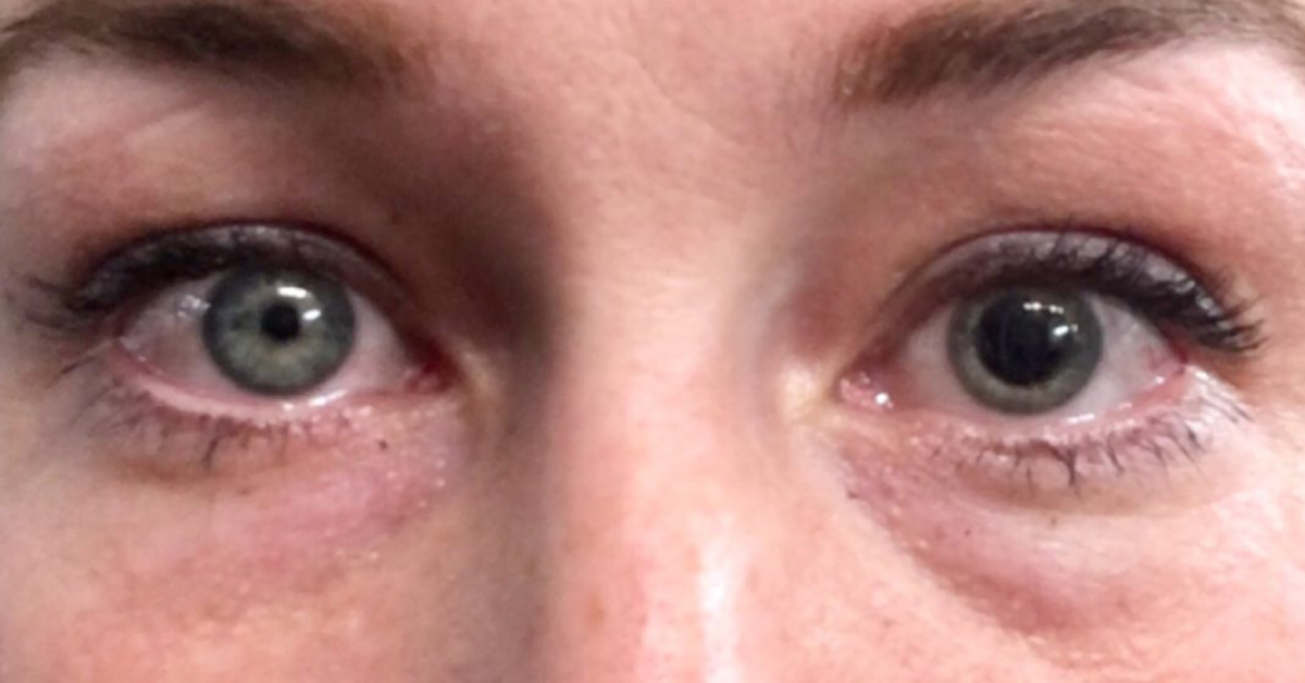 Visual And Ocular Manifestations Of Alzheimer's Disease