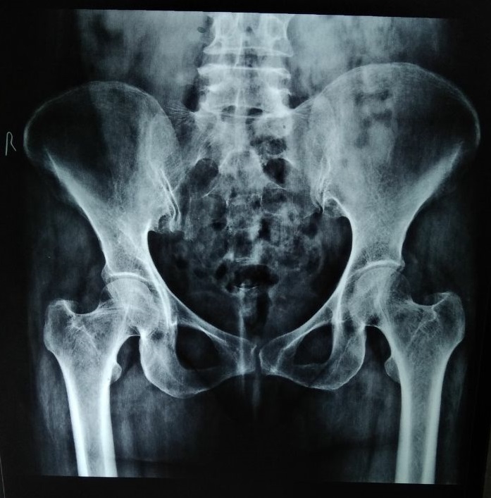Diagnose The Bilateral Antalgic Gait