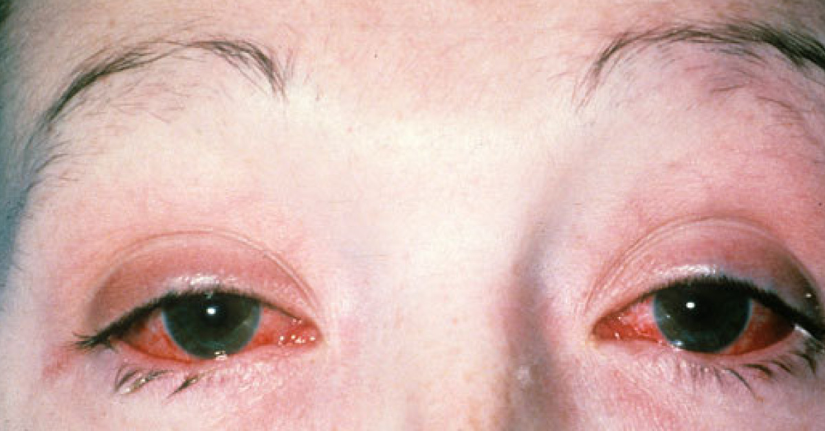 Brief Review On Rieters Syndrome