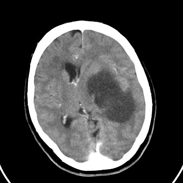 Man With Subacute Cognitive Decline And Dizziness