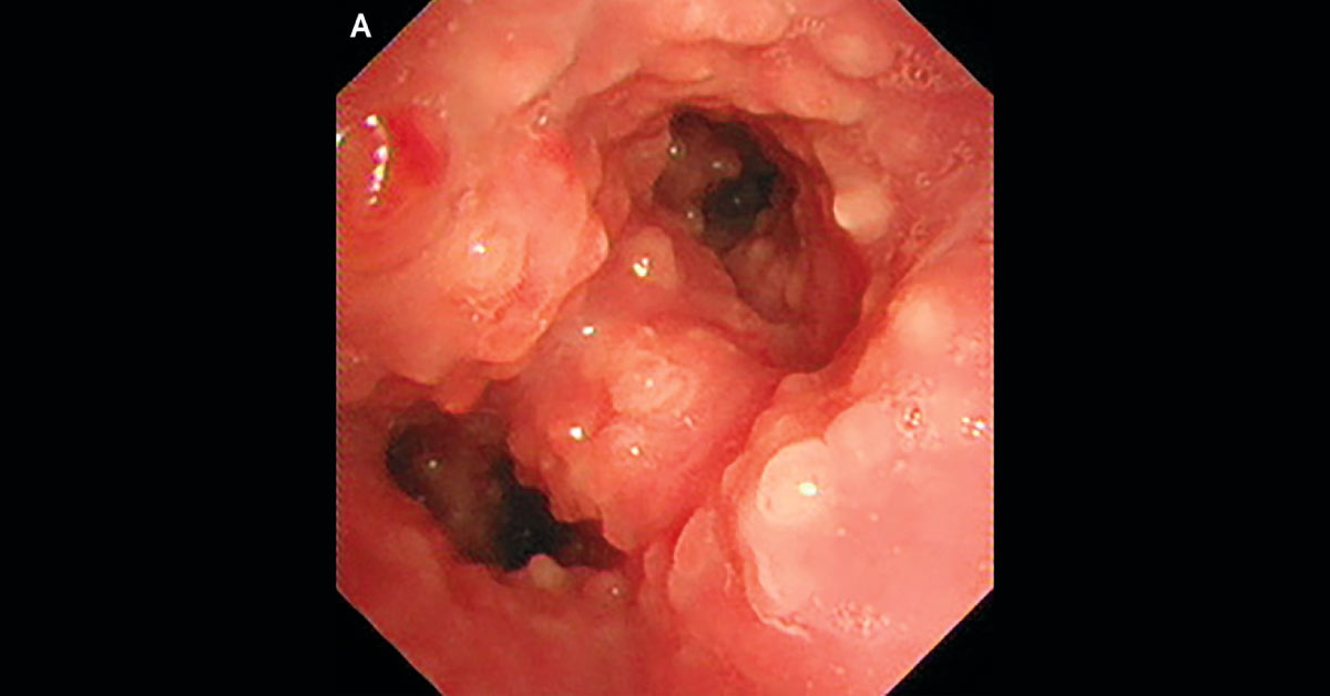 Identify the Reason for Nonproductive Cough in This Woman
