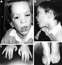 Ocular Findings In Family With Cerebral Gigantism Sotos Syndrome