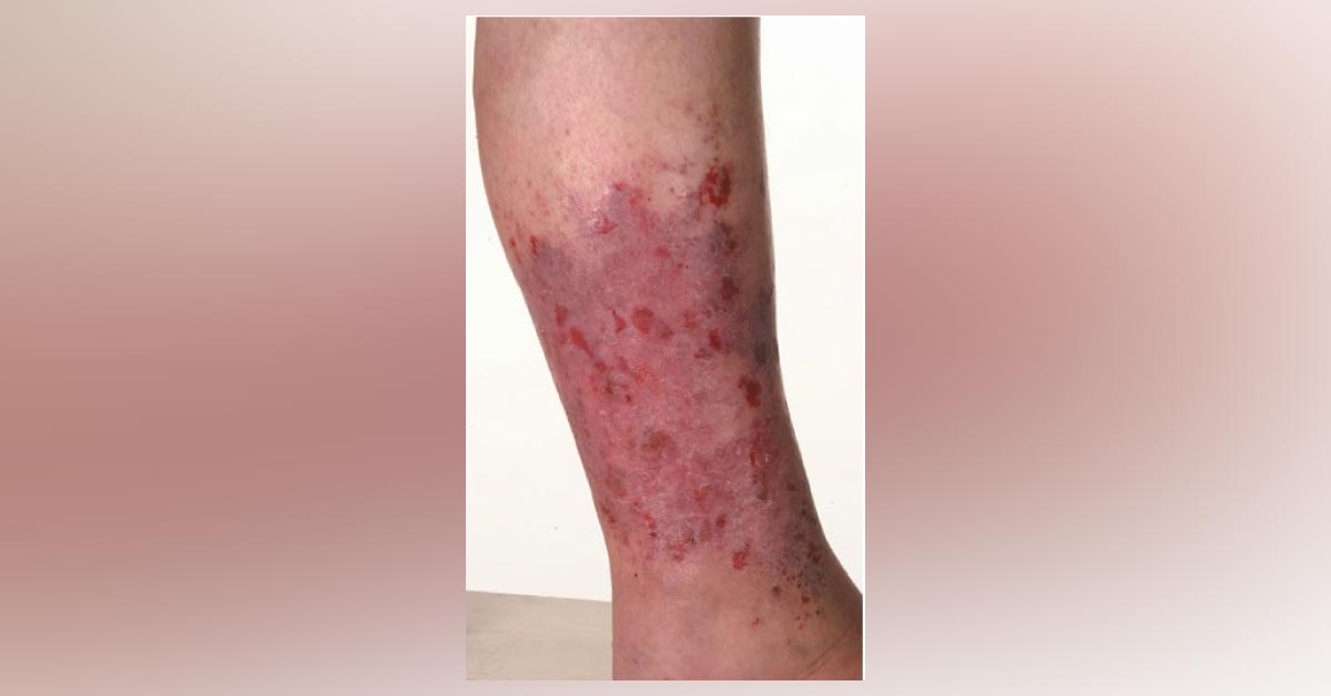 Erythematous Eruption On The Lower Legs