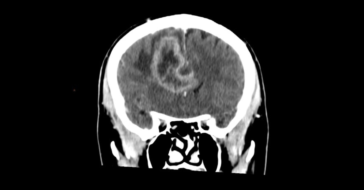 Male With Headache And Slurring Of Speech