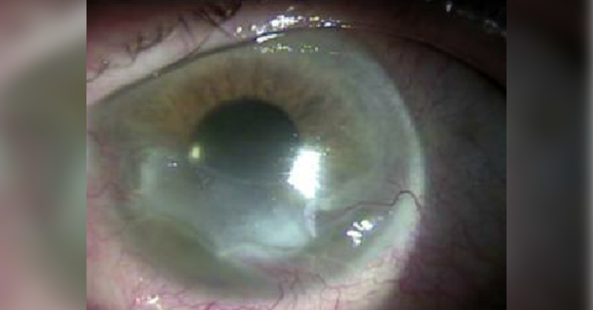 Neuro Ophthalmic Considerations In Trigeminal Neuralgia And Its Surgical Treatment