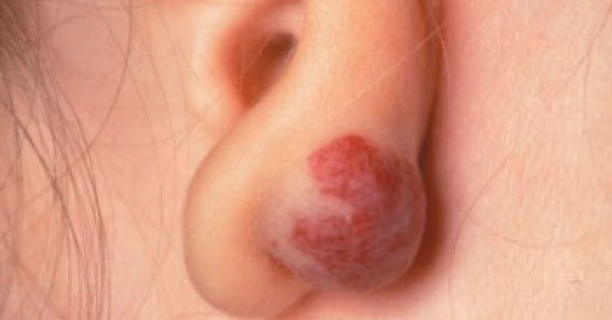 A Regressing Vascular Lesion: How Will You Manage?