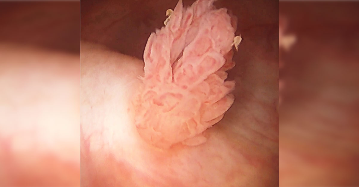 Case of a Woman with Hematuria and a Defect in the Right Ureter