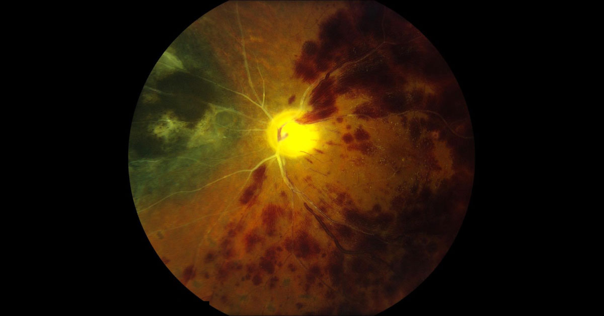 Spot This Ophthalmic Abnormality