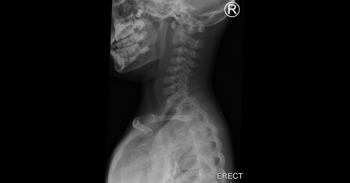 Case of a Pediatric Patient with Difficulty in Opening the Jaw