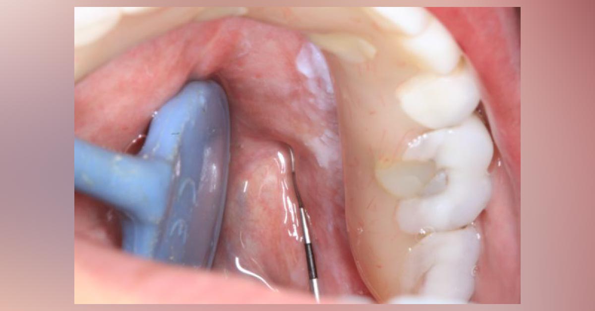 A White Lingual Lesion: What Can Be the Cause?