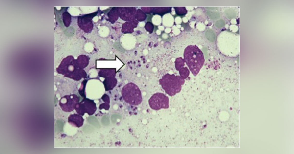 Case of a Man with Fever of an Unknown Origin
