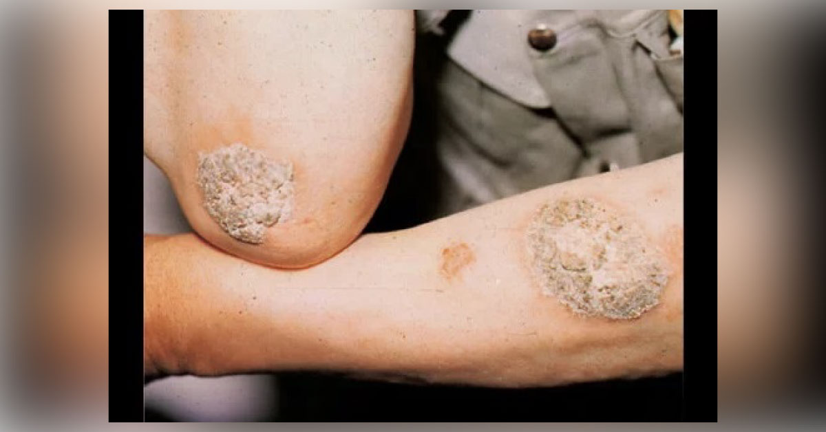 Identify This Infectious Condition