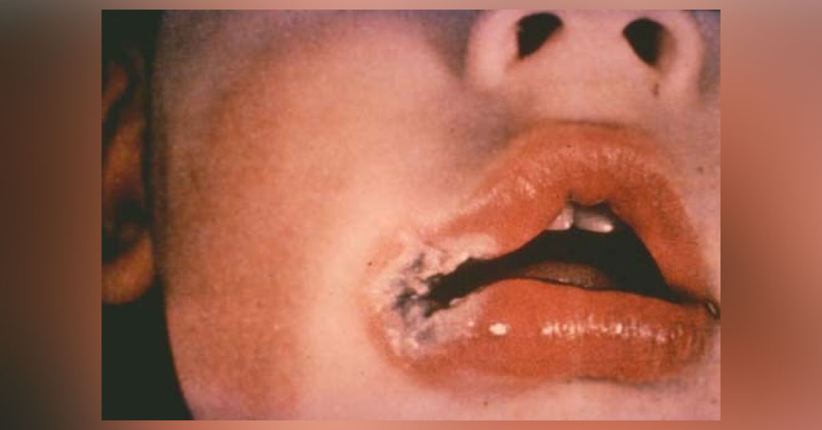A Case of Lip Trauma