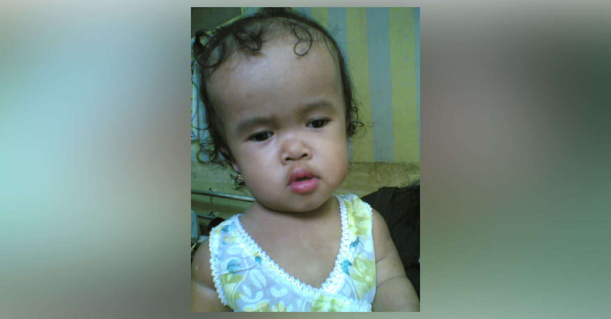 Brief Review On Ocular Manifestations Of Achondroplasia