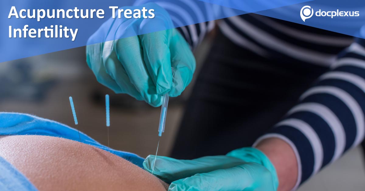 Acupuncture Boosts Ovulatory Dysfunction Treatment
