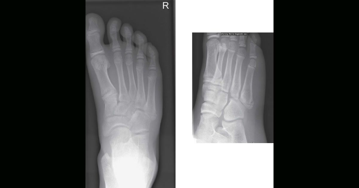 A Teenager with a Painful Foot