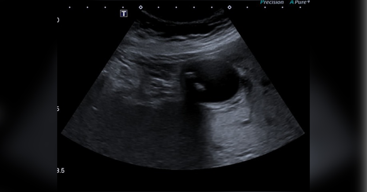 Case of a Patient with Right Upper Quadrant Pain and Elevated Bilirubin Levels