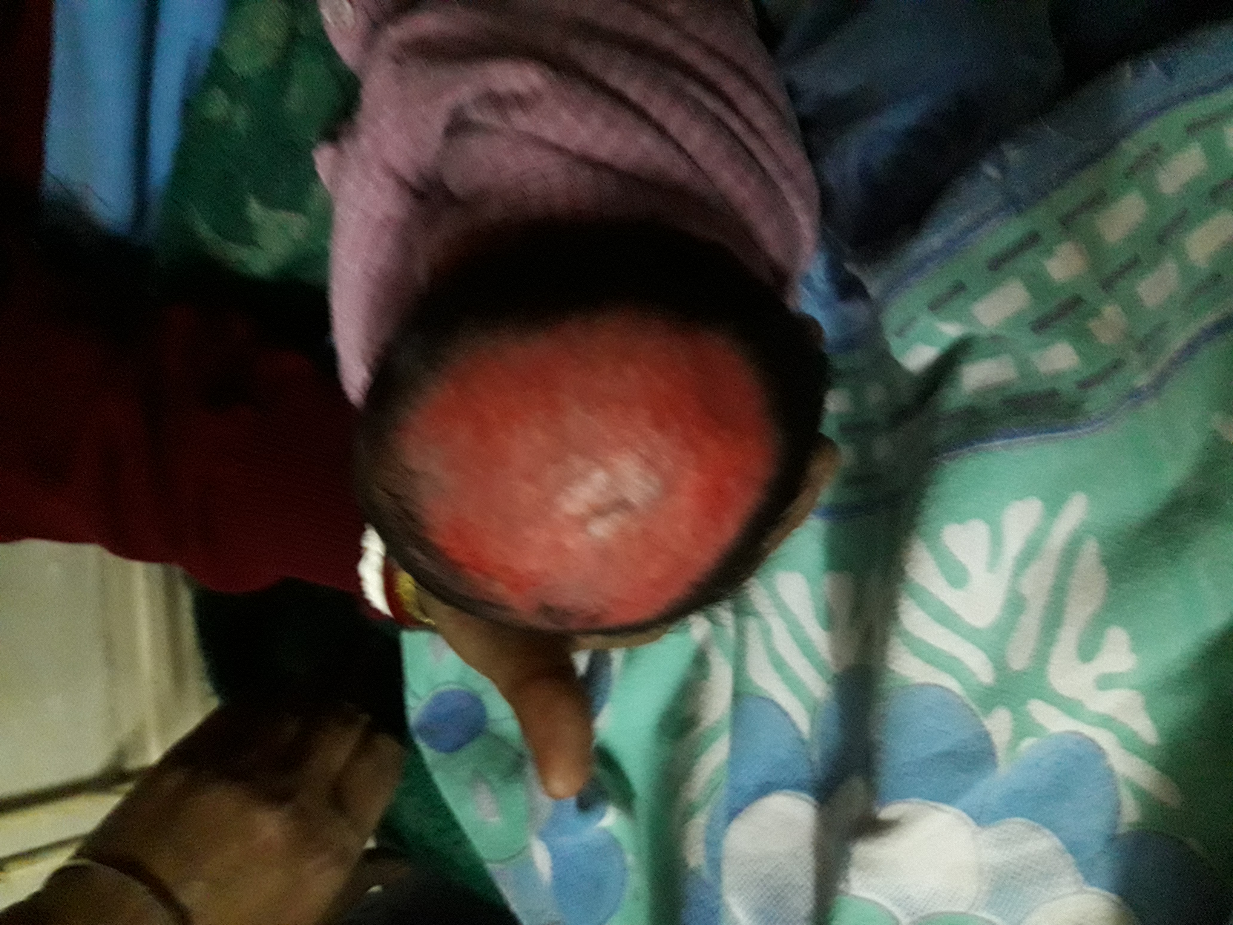 Newborn With Scalp Abnormality