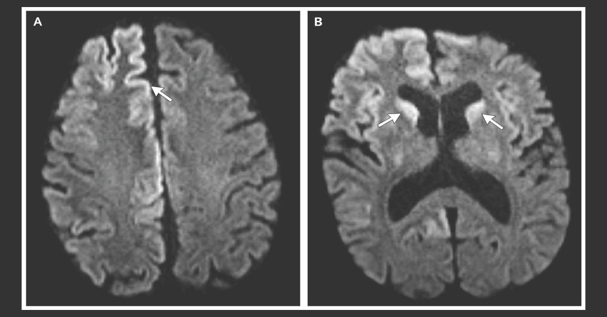 Cognitive And Functional Deterioration