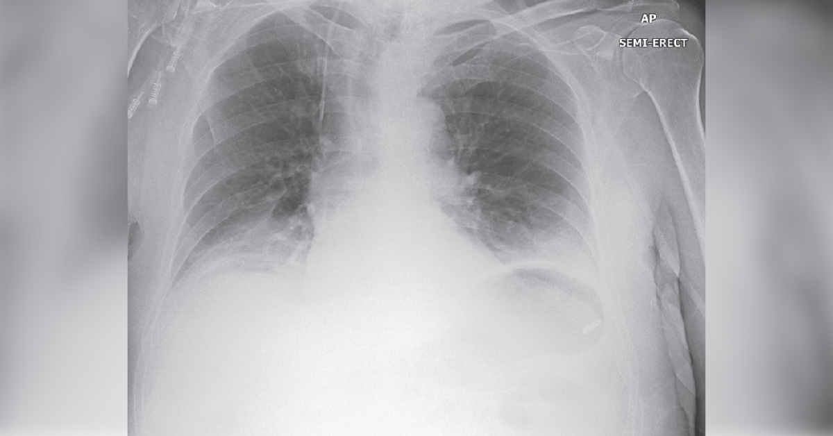 Peptic Ulcer Repair And Postoperative Complication