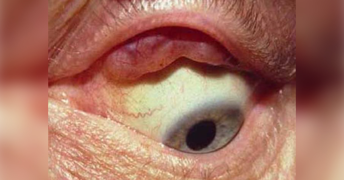 Brief Review On Lacrimal Gland