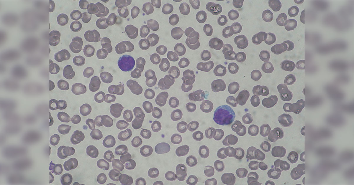 What does the peripheral blood smear reveal?