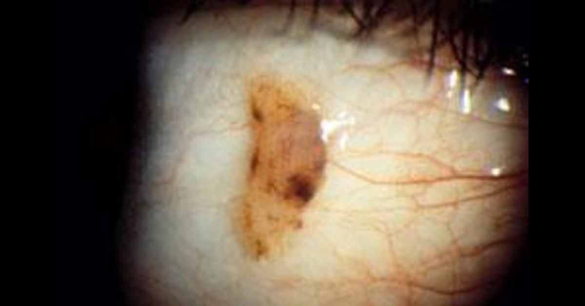 Brief Review On Nevus Of Eye