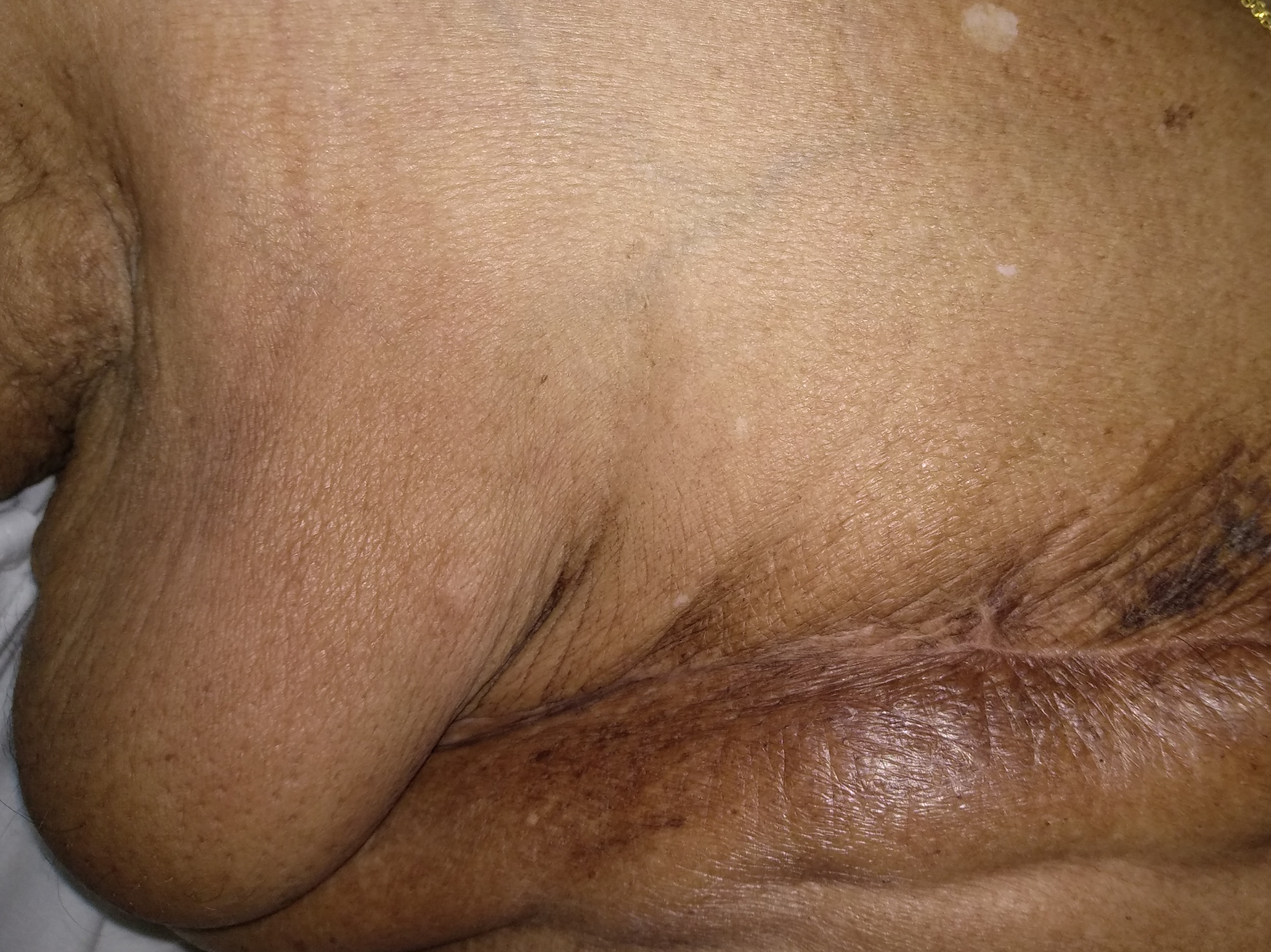 Management Of Axillary Swelling In Elderly