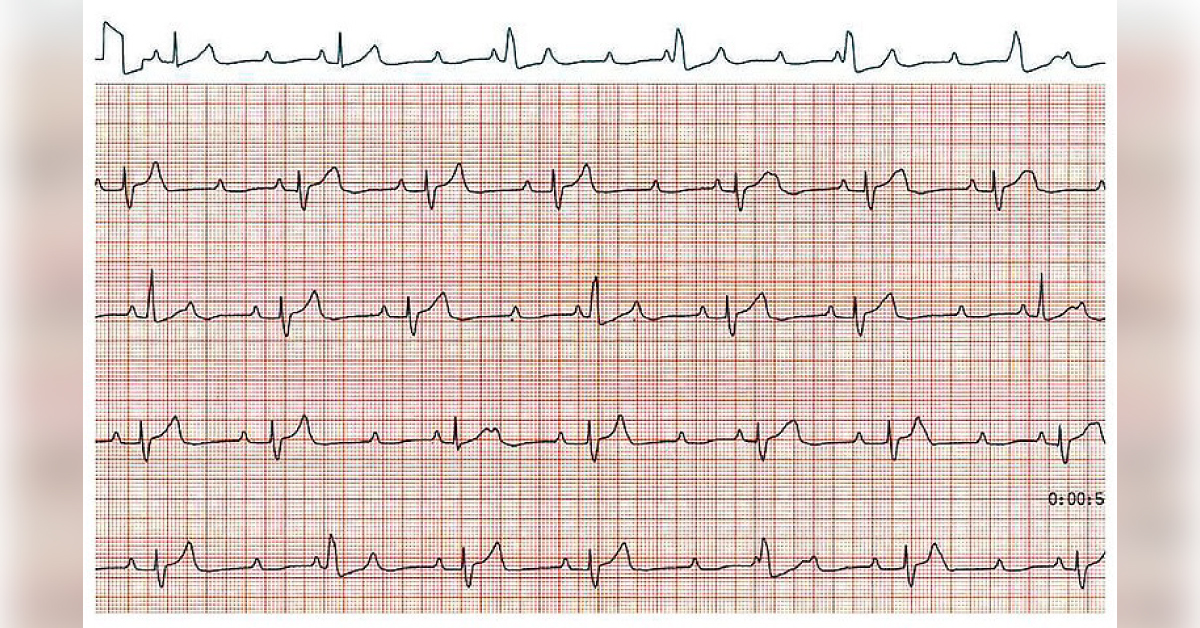 Spot This Cardiac Abnormality