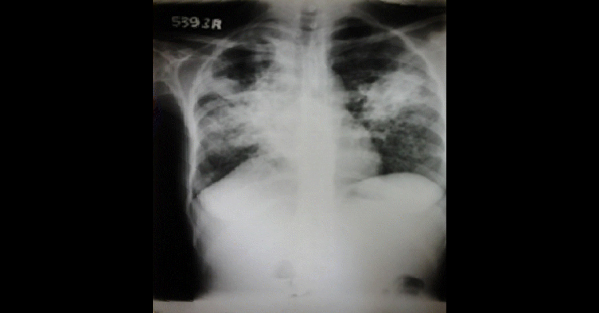 Fever With Productive Cough and Lower Limb Swelling