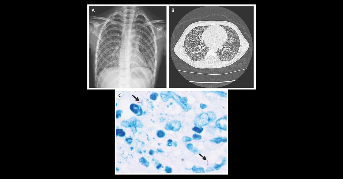 Is this a Case of Drug Resistant TB?