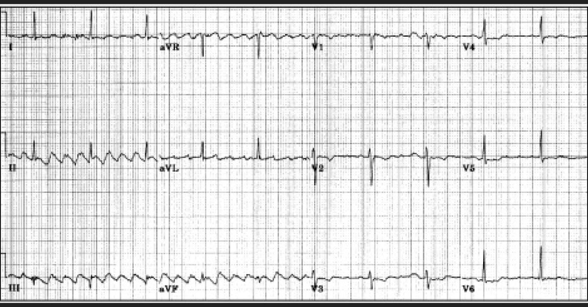 What Does This ECG Suggest?