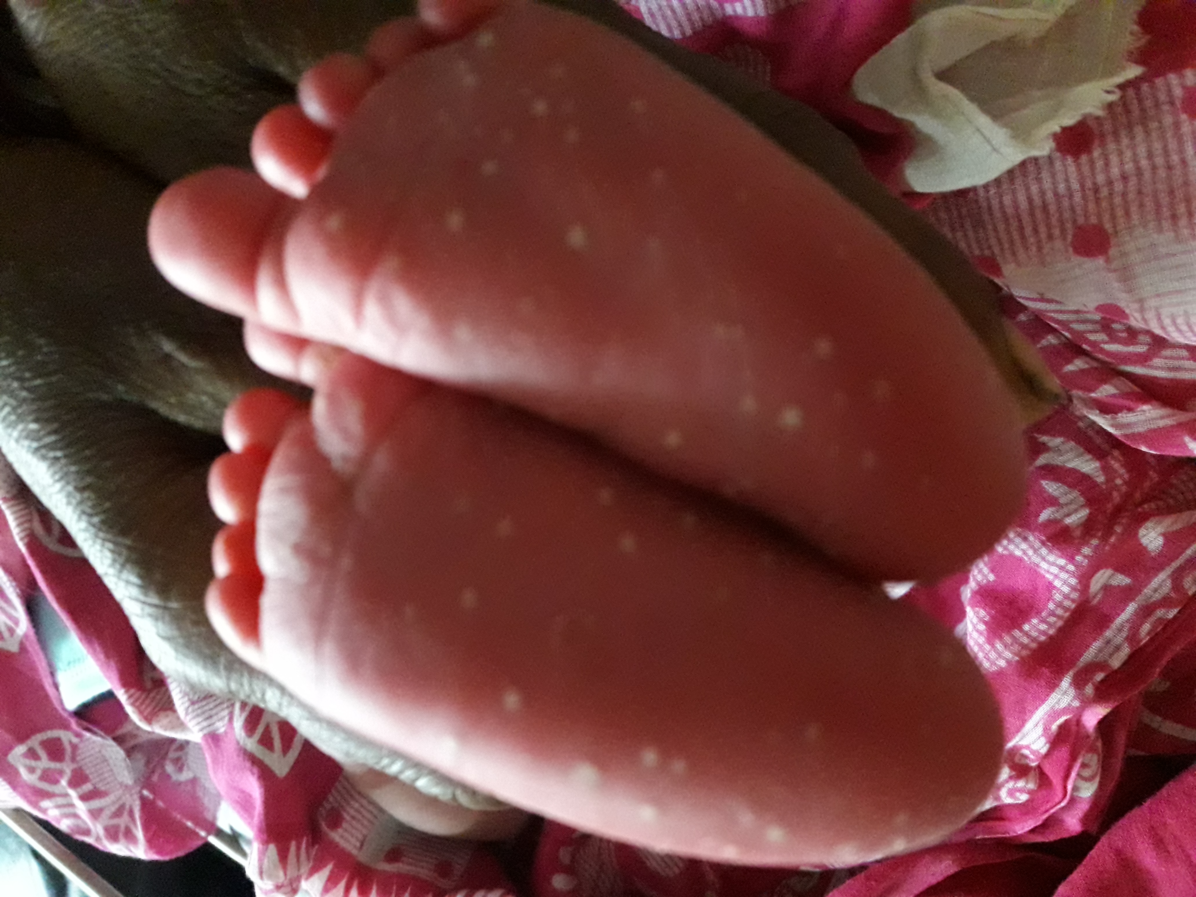 A Newborn with Abnormal Sole Skin