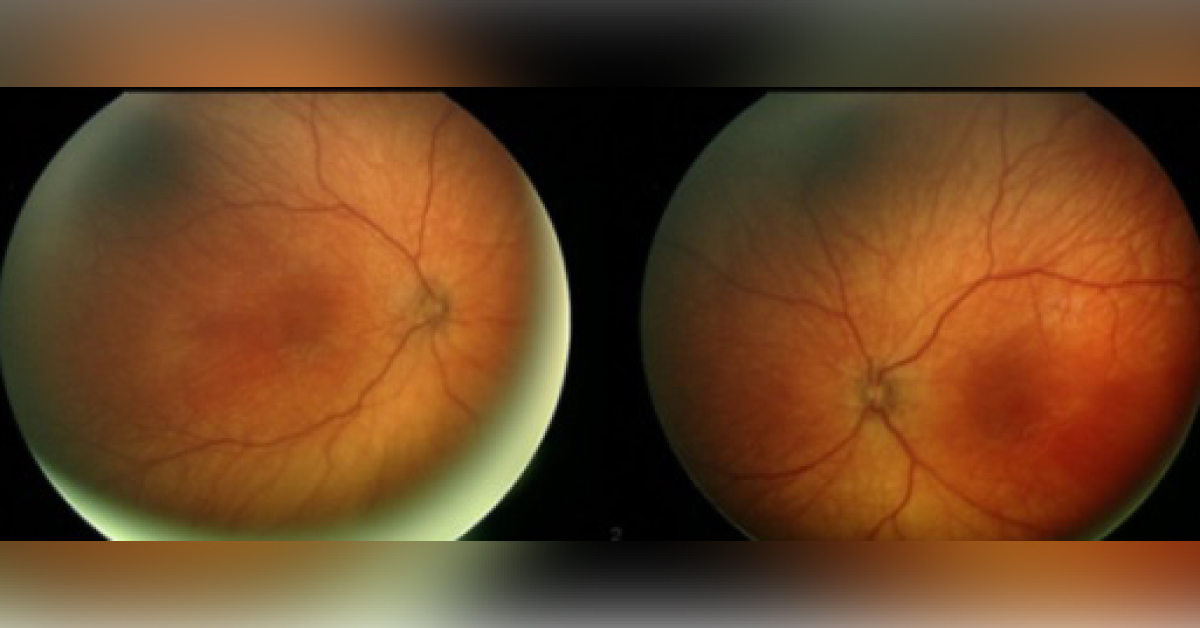 A Case of Poor Eye Fixation