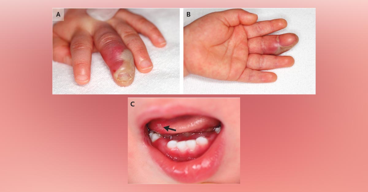 Fever, Erythema, And Swelled Finger Of 1 year Old Girl