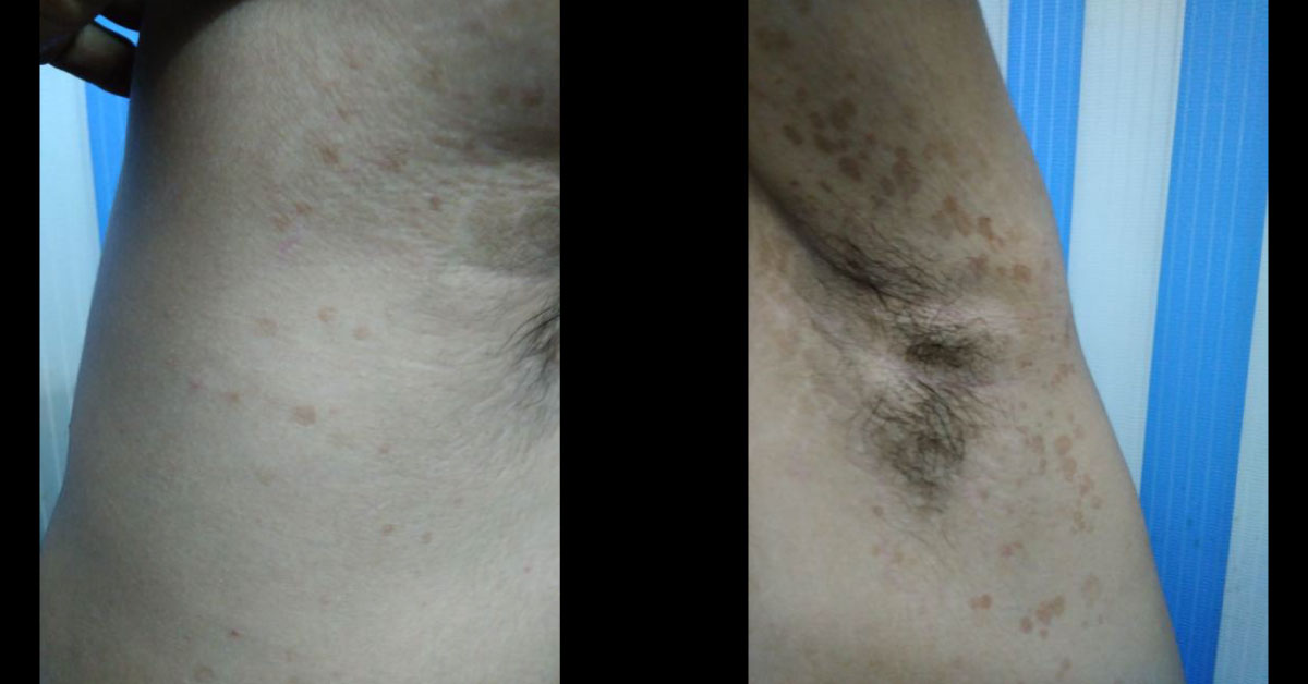 Diagnosis The Skin Lesion