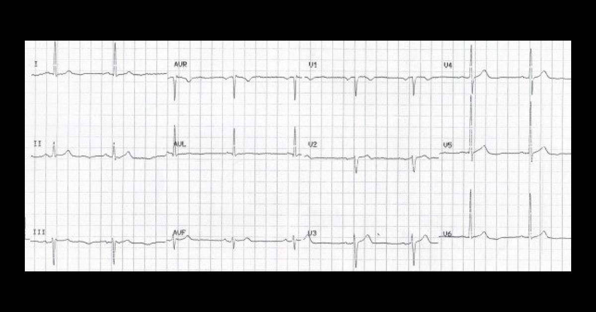 Interpret This ECG