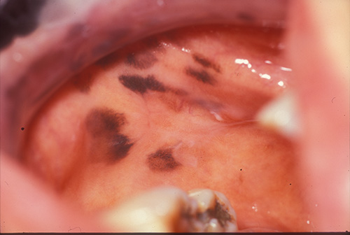 Woman with Hyperpigmented Macules on the Buccal Mucosa