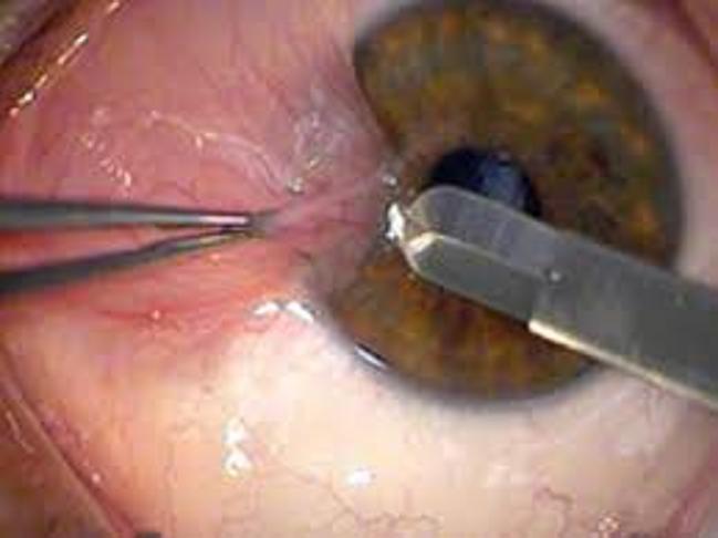 Brief Review On Surgical Modalities Of Pterygium