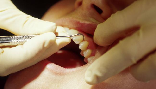 Antimicrobial Particles Form A New Best Filling Material For Tooth Decay