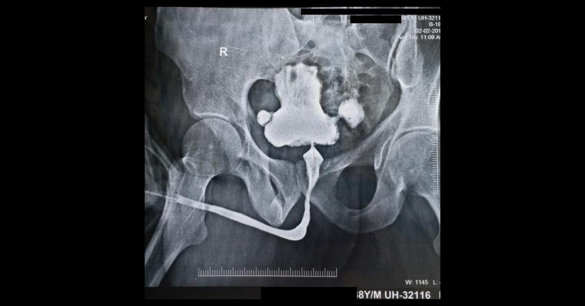 Complex Stricture Urethra