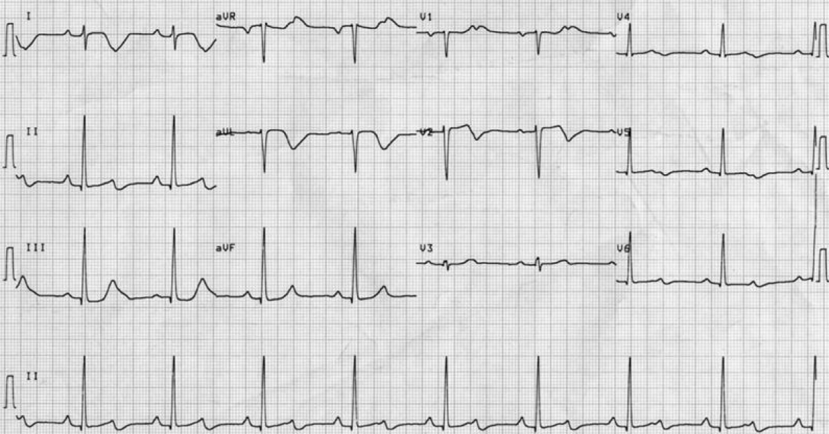 Identify the Cardiac Abnormality