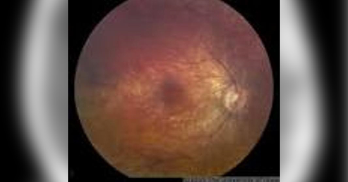 A Brief Review On Ocular Manifestatios Of Lebers Amaurosis