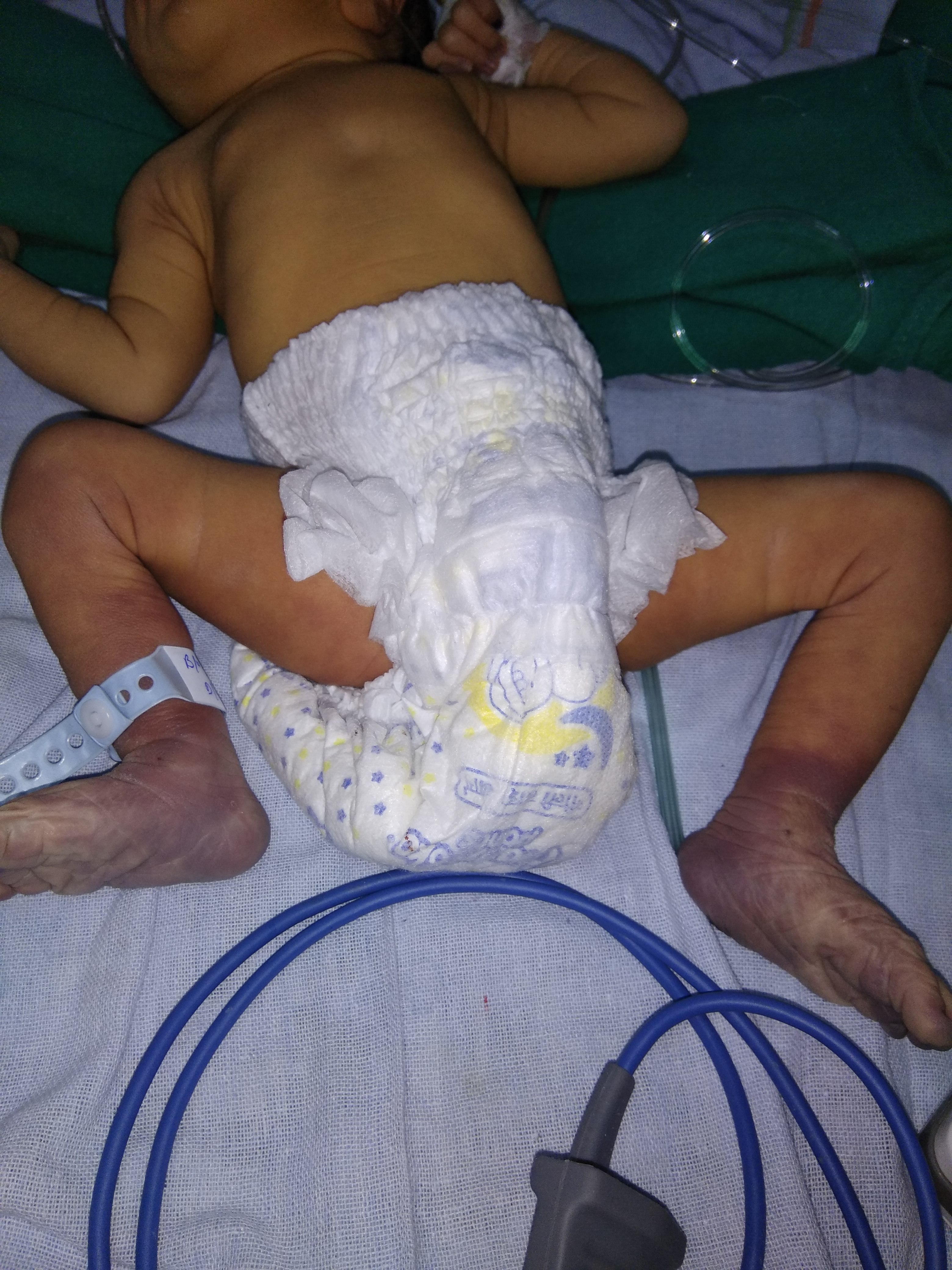 RDS Baby With Bluish Discoloration Of Both Feet