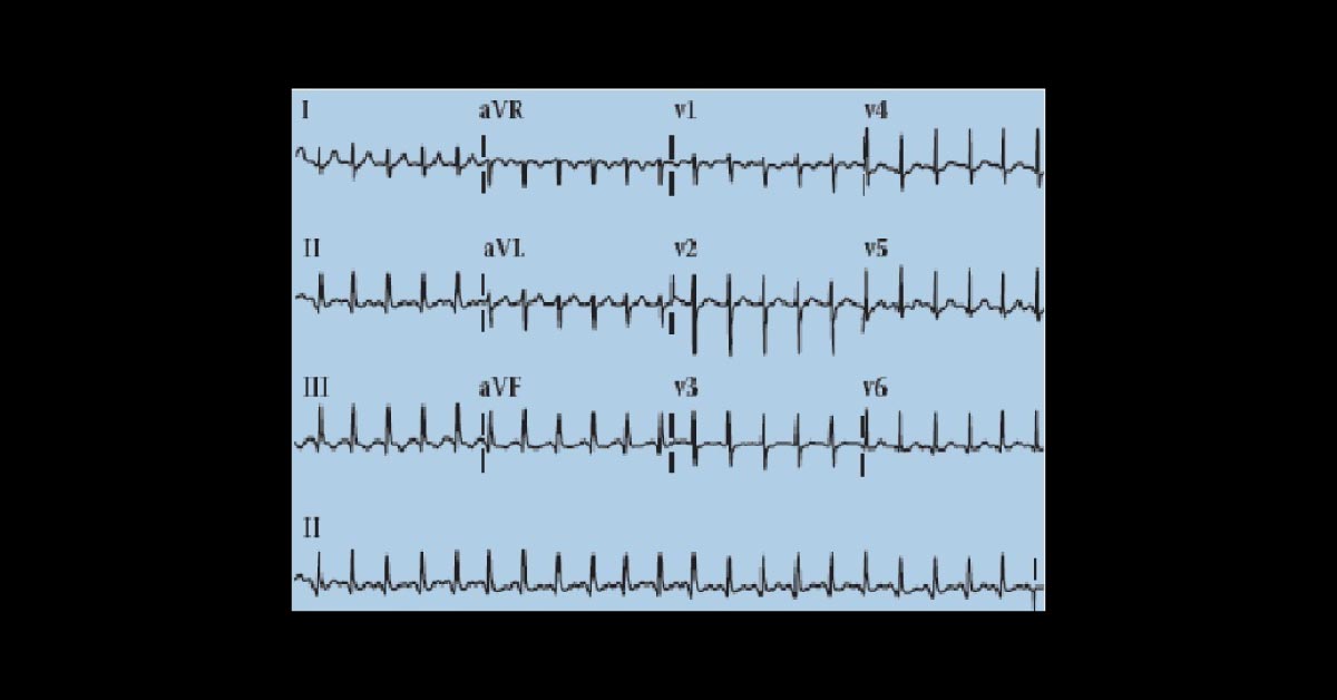 Identify the Most Likely Postoperative Complication