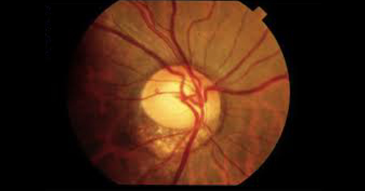 Brief Review On Tilted Disc Syndrome