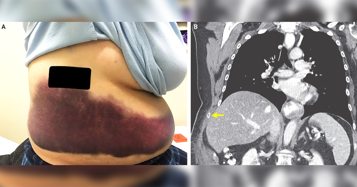 Coughing And Severe Pain In The Right Flank